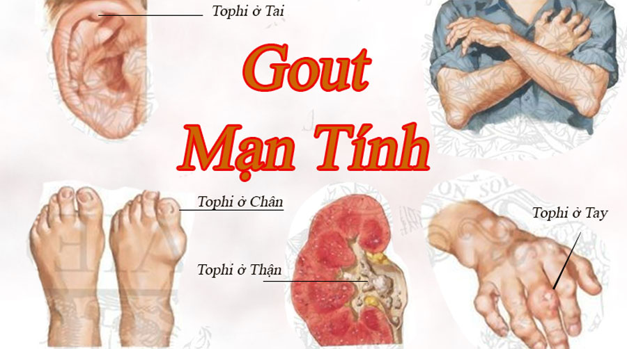Bệnh gout gây đau nhức, biến dạng khớp và để lại nhiều di chứng nặng nề